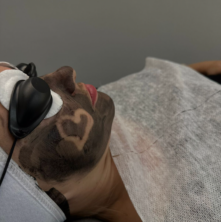 Карбоновый пилинг