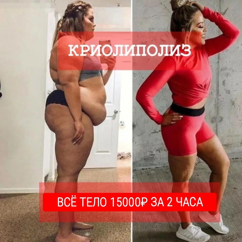 Криолиполиз Тотал / Всего тела/