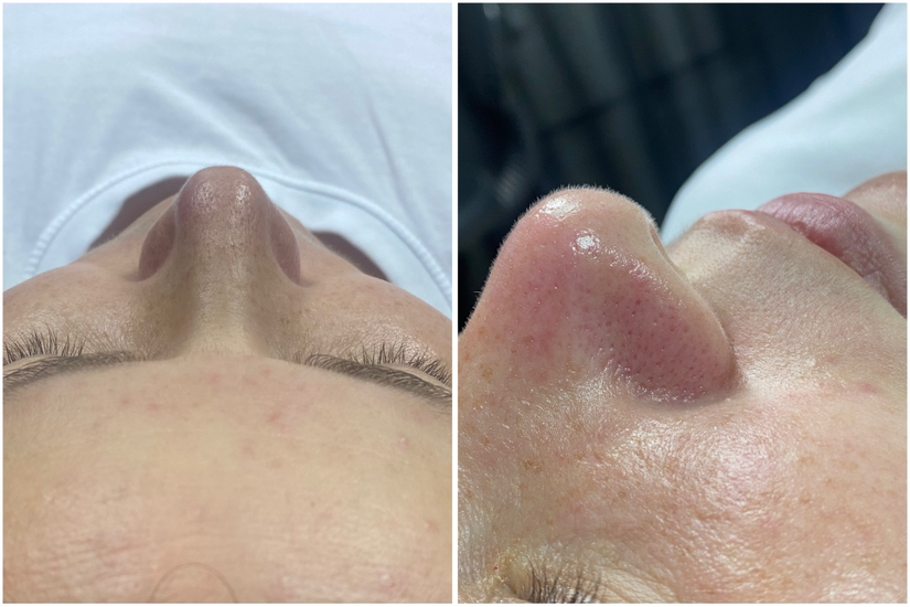 Чистка лица