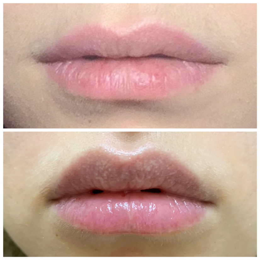 Инъекционное увлажнение губ