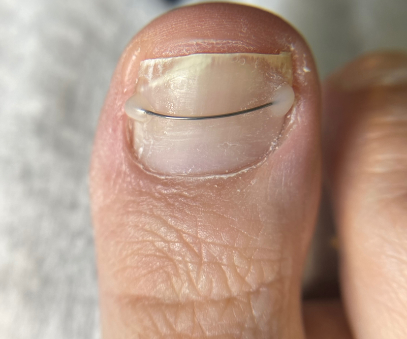 Титановая нить