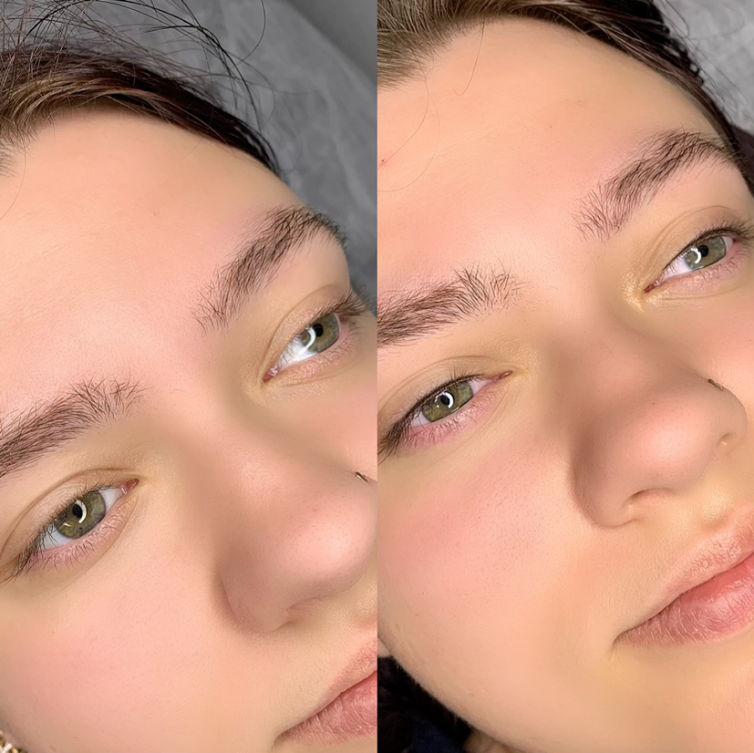 Коррекция межресничного пространства