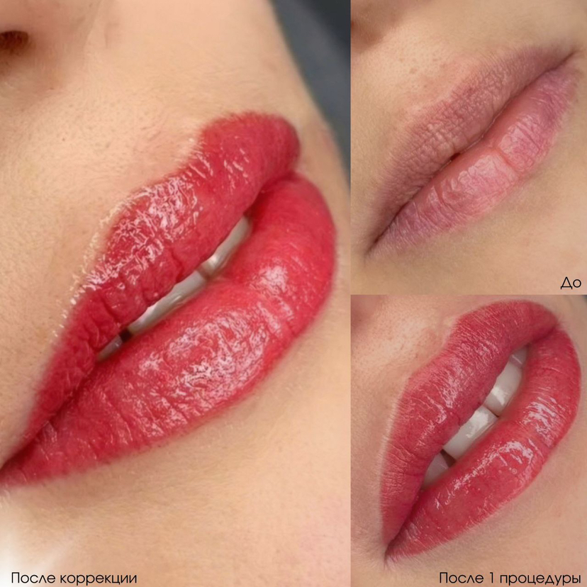 Коррекция губ через 21 день после Первоначальной процедуры