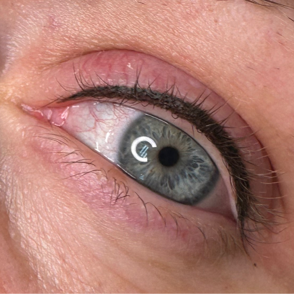 Межресничка