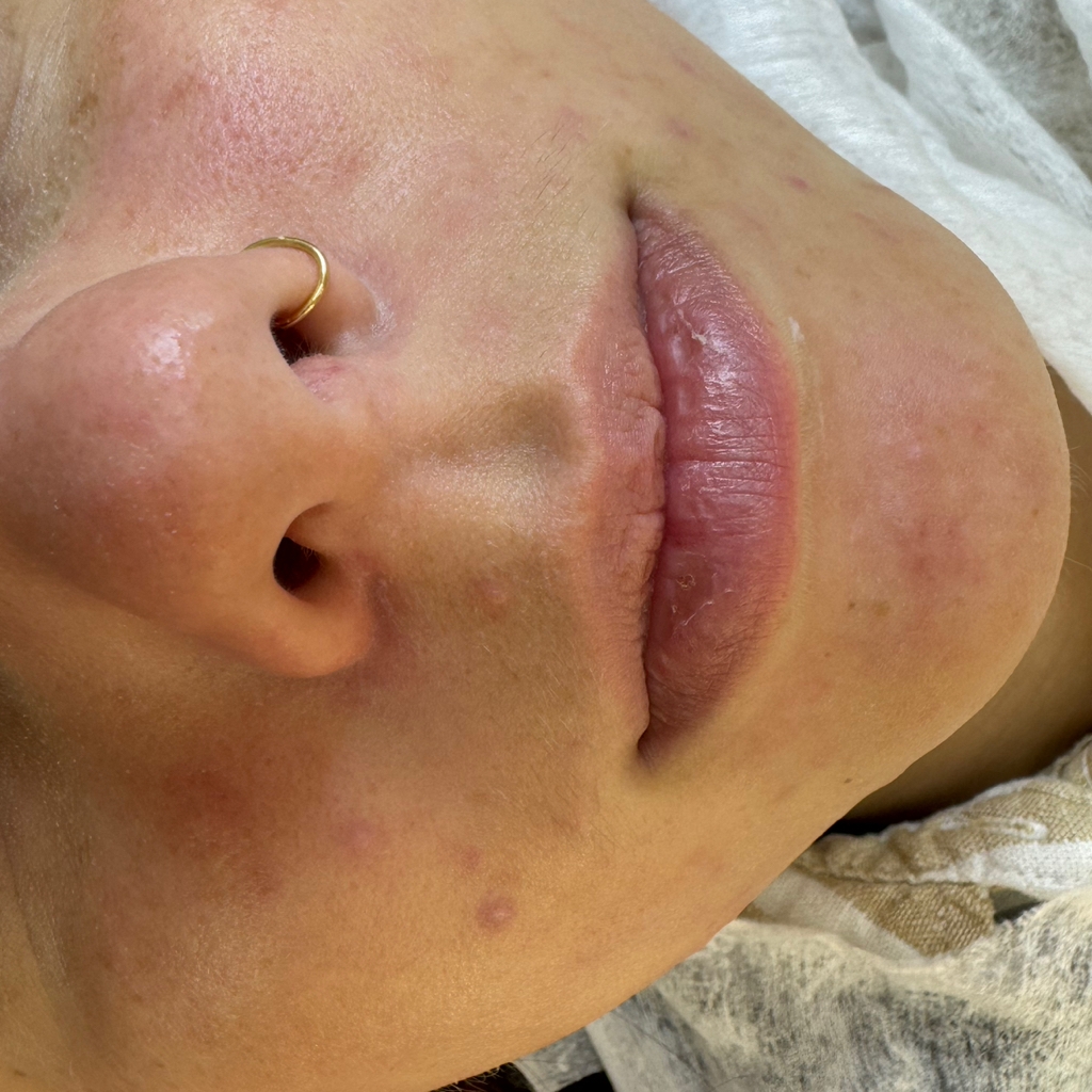 АКЦИЯ: Комбинированная чистка лица (ультразвук + механика)  на проф. космецевтике BCMED, peel medical