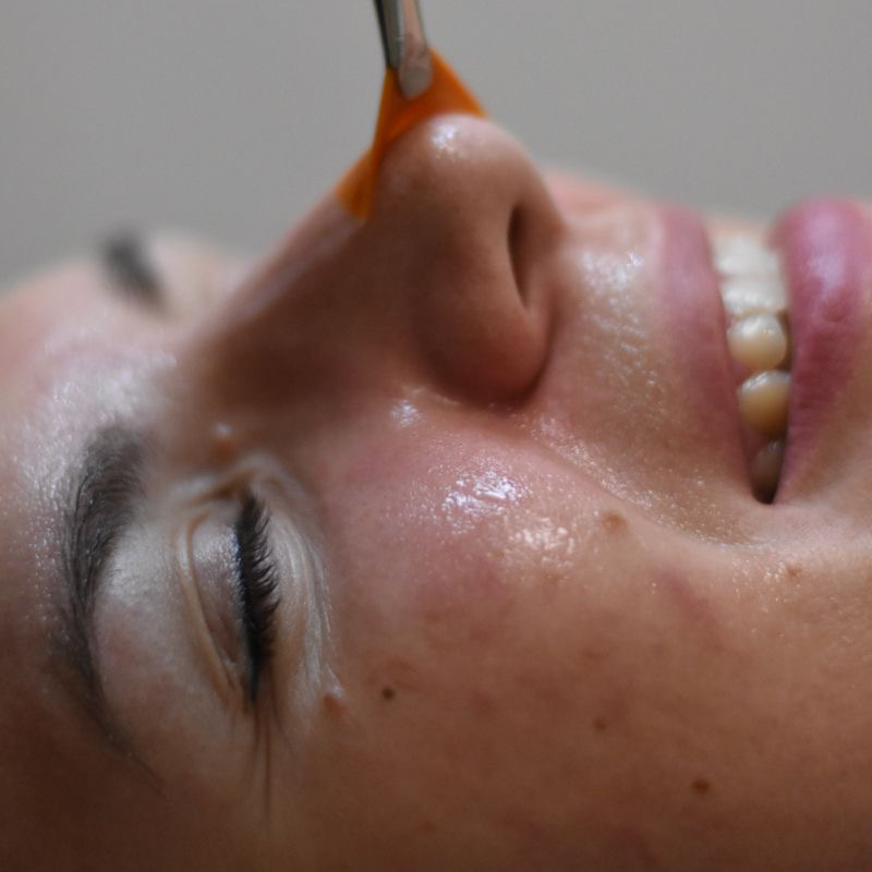 Карбокситерапия