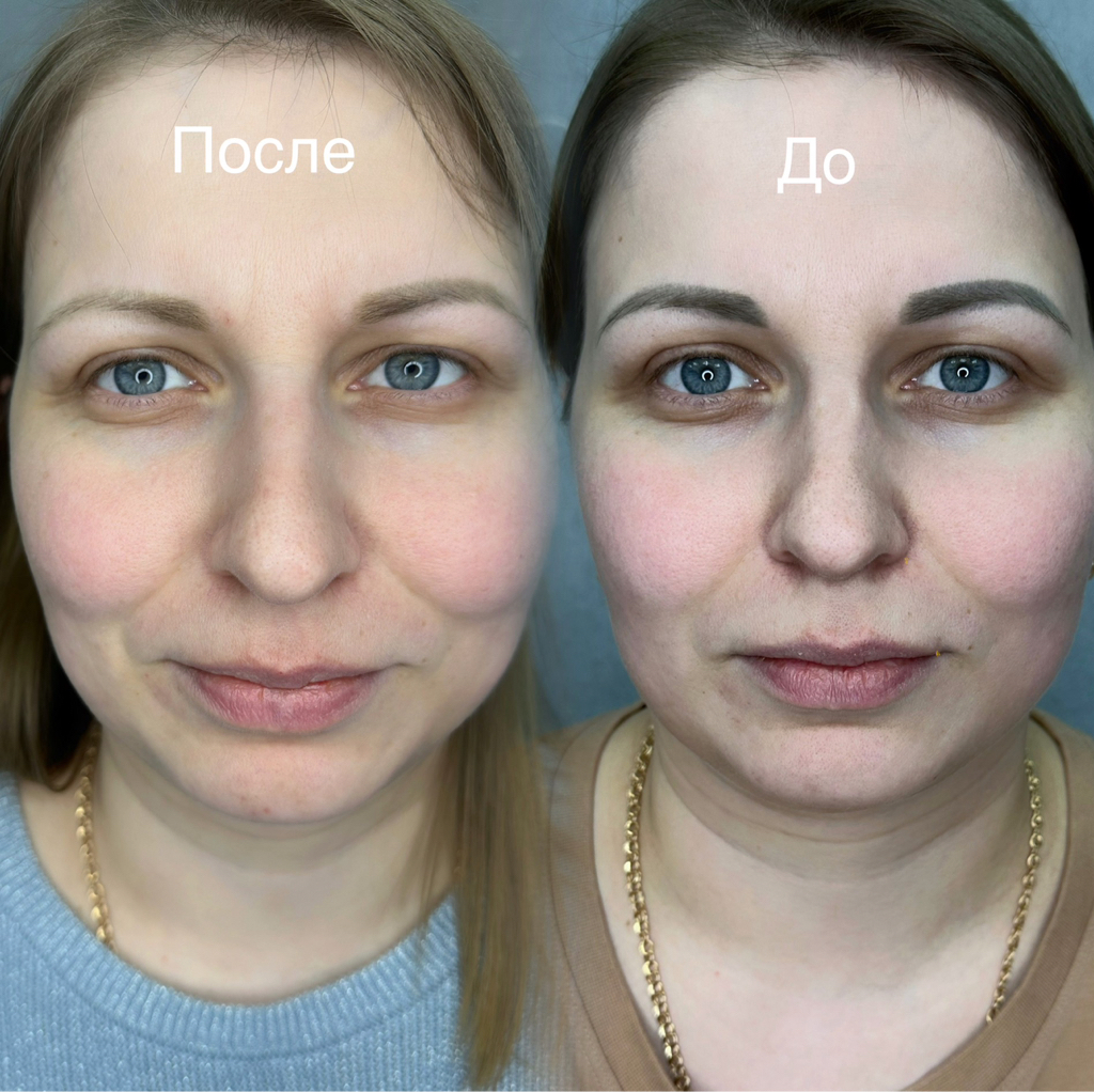 Удаление татуажа Комбо (лазер+ремувер)