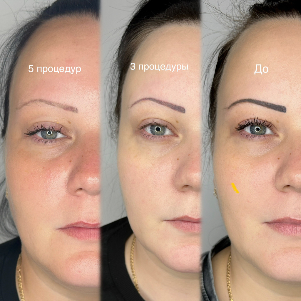 Удаление лазером (брови, веки, губы)