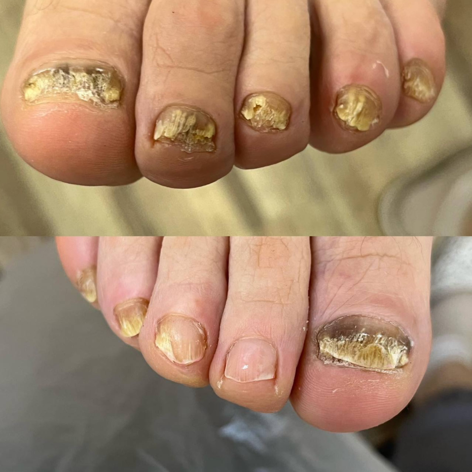 Подологическая обработка стоп и ногтей (2 категория сложности)