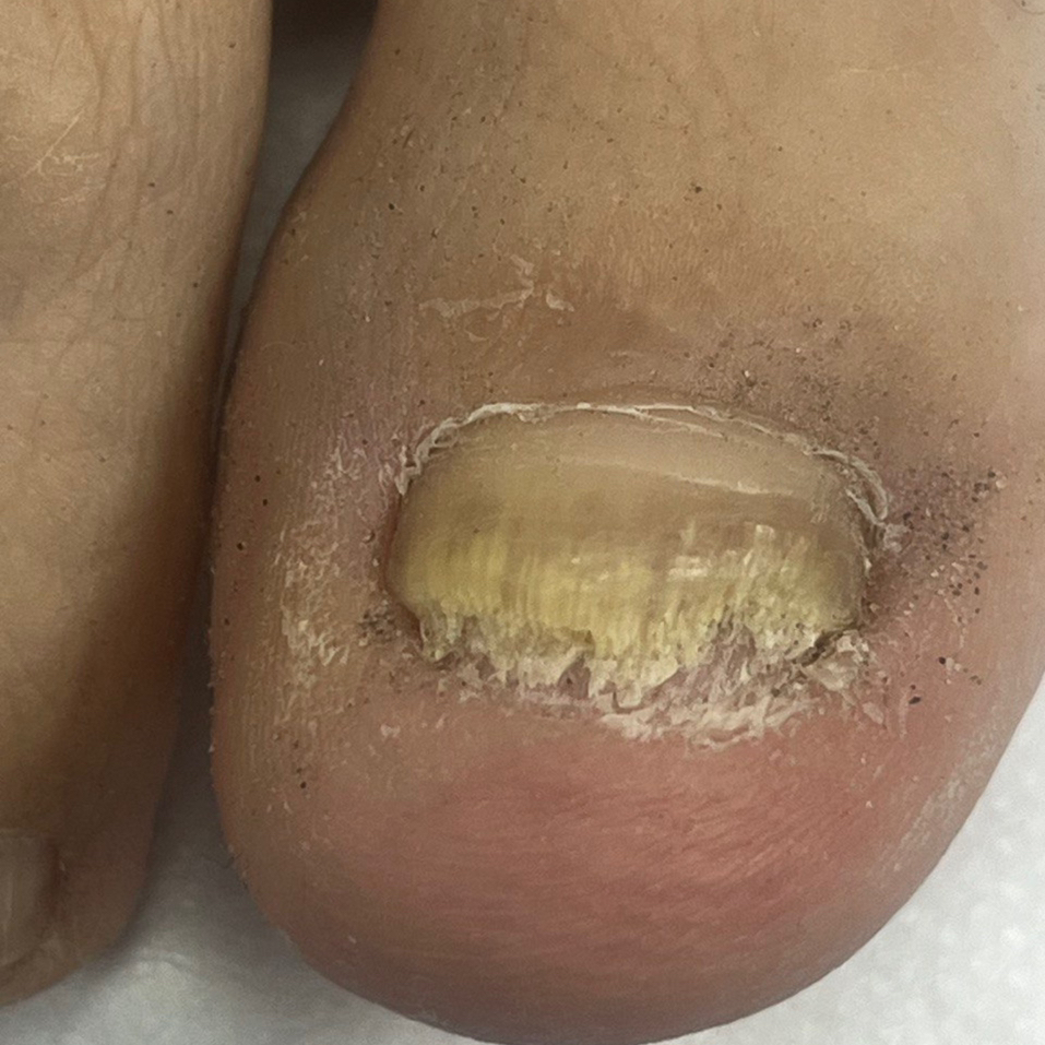 Зачистка грибкового поражения (1 ноготь)