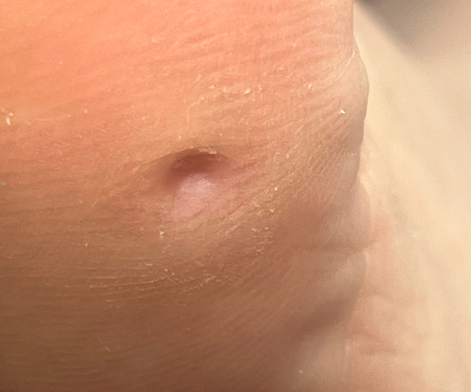 Обработка стержневой мозоли на стопе (1 шт.)