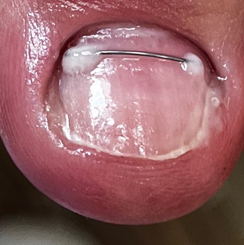 Установка титановой нити