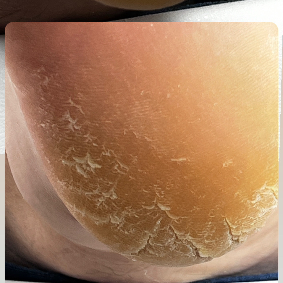 Локальная обработка отдельных участков стопы