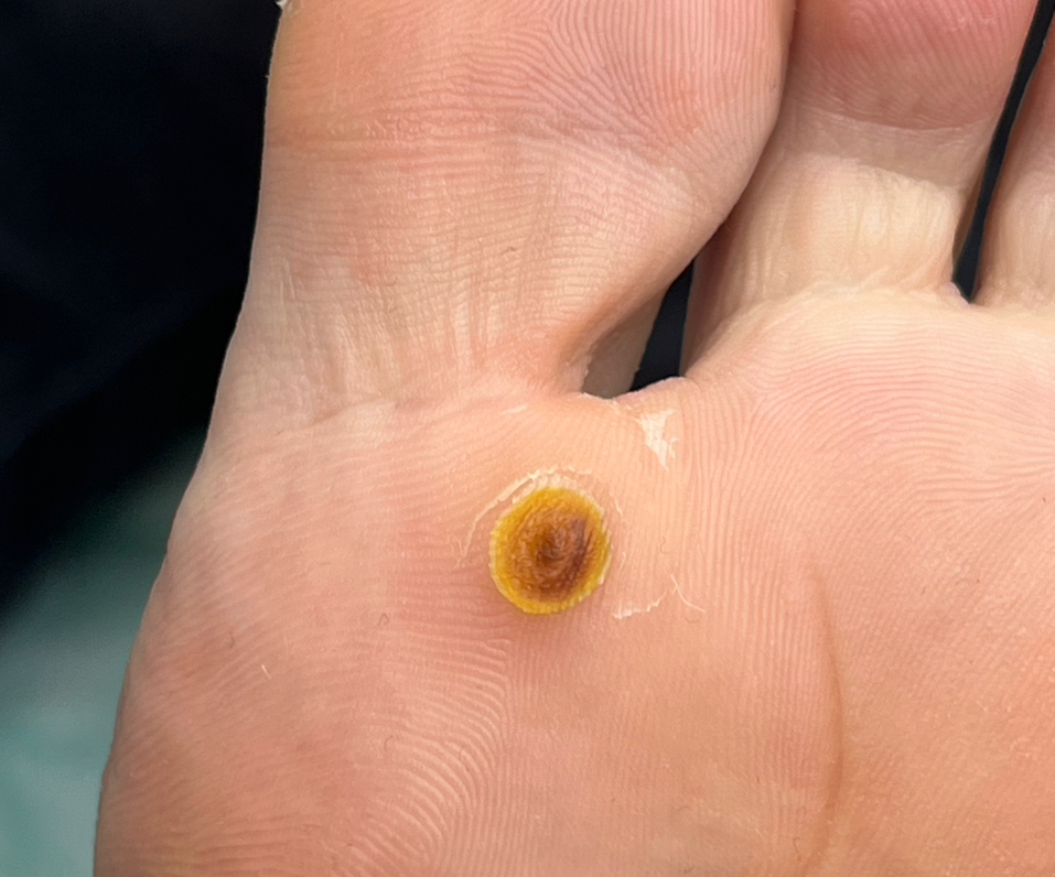 Обработка бородавки (до 3-х шт.)