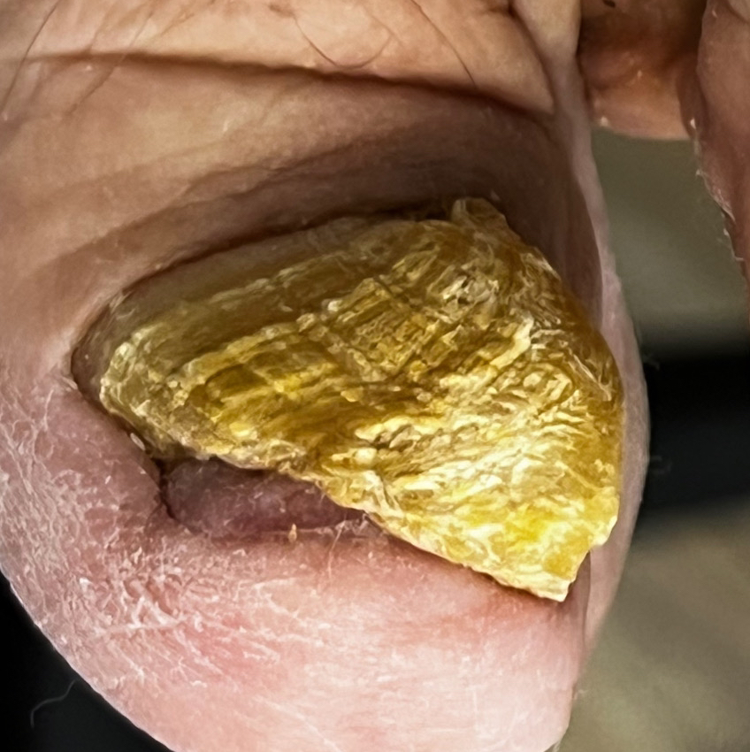 Зачистка грифоз (1 ноготь)