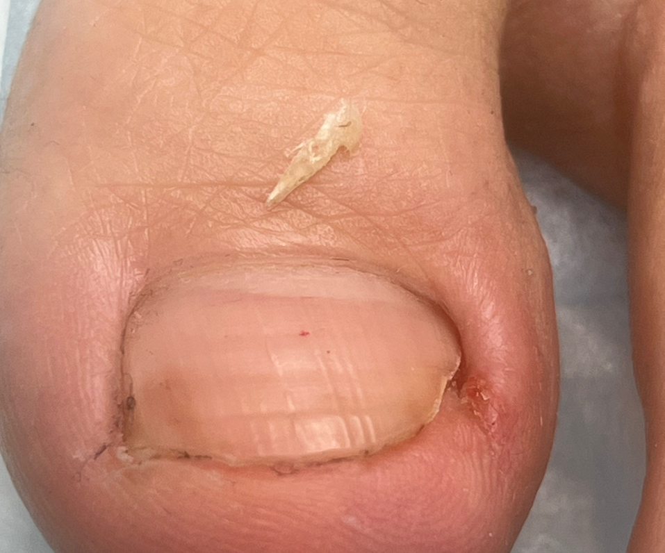 Работа с вросшим ногтем  (1 категория сложности)