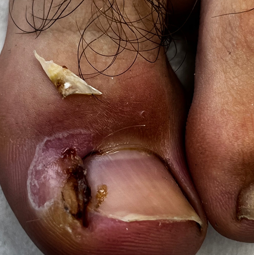 Работа с вросшим ногтем (2 категории сложности)