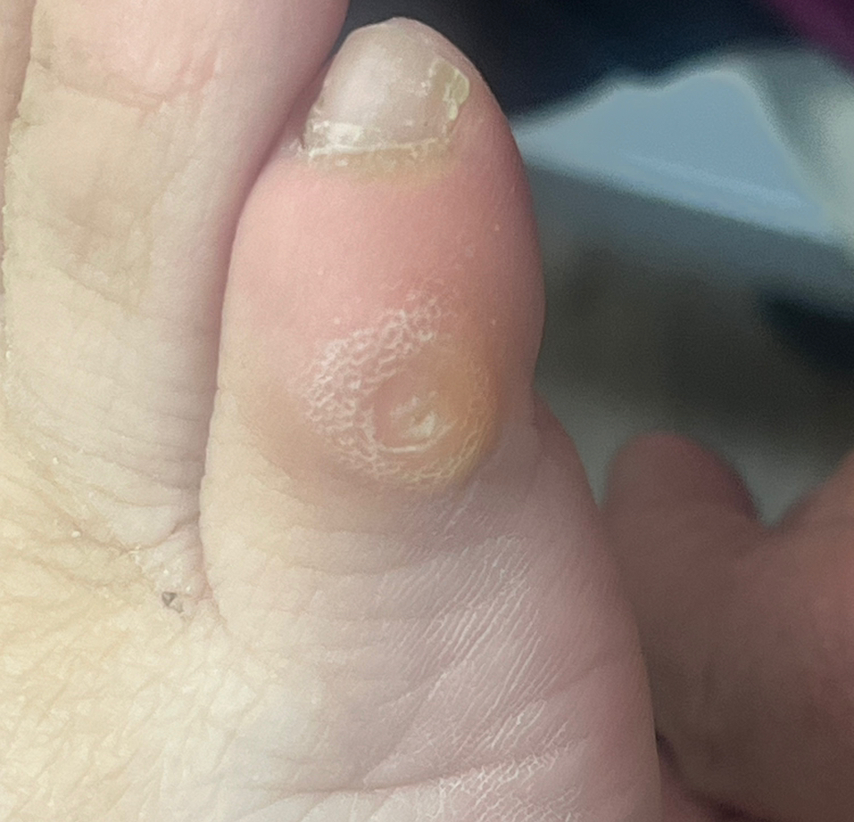 Обработка межпальцевой стержневой мозоли (1 шт.)