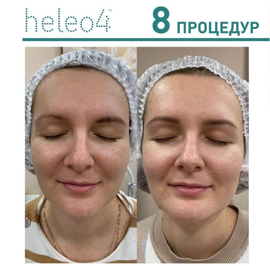 HELEO 4 фотобиомодуляция ( светолечение )