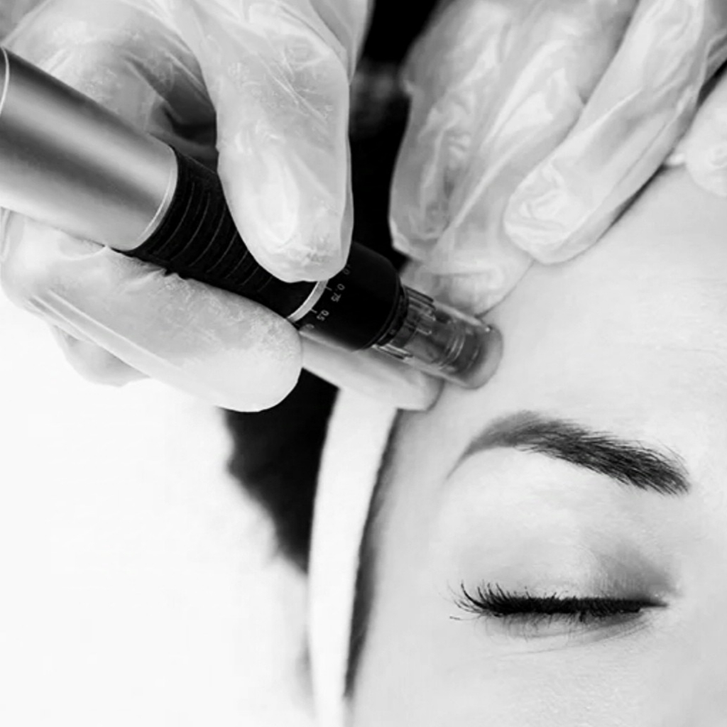 Фракционная мезотерапия (микронидлинг)