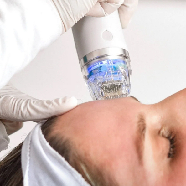 Микроигольчатый RF лицо/шея/декольте (3 сеанса)