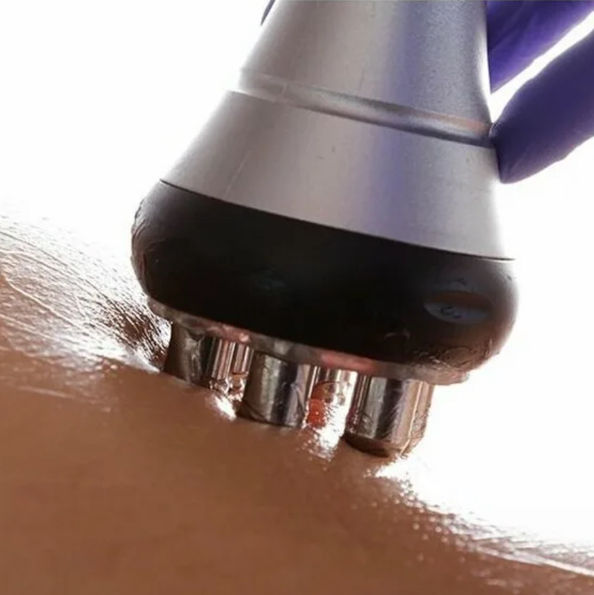 RF одна зона тело