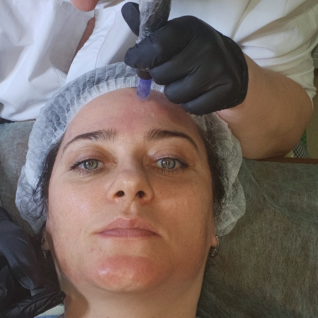 Фракционная мезотерапия