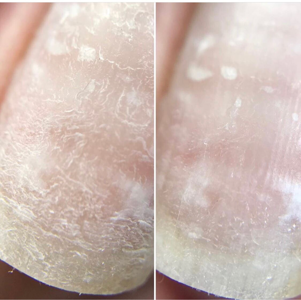 Система укрепления MAGNETIK для восстановления ногтевой пластины