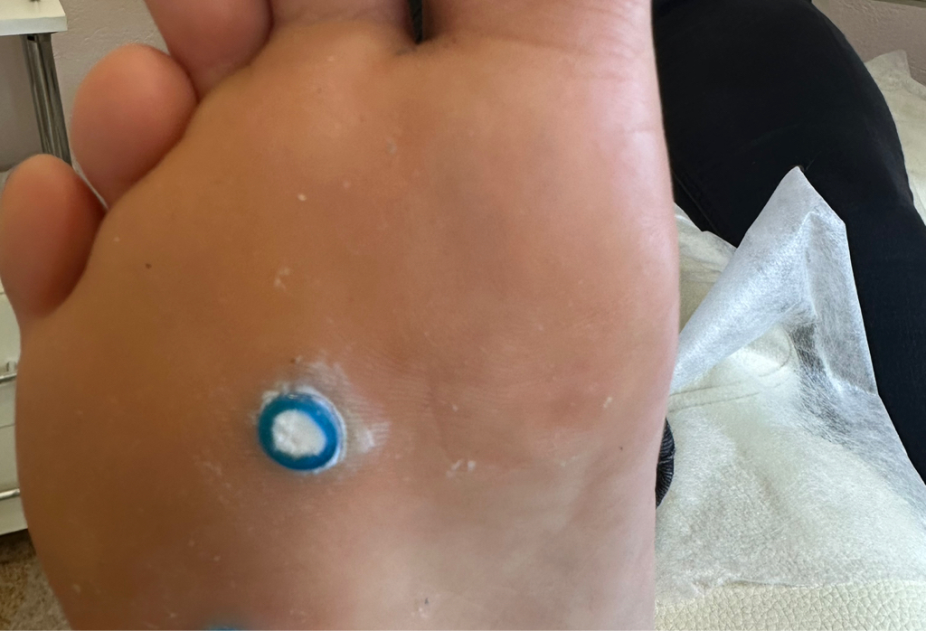 Обработка стержневой мозоли/бородавки