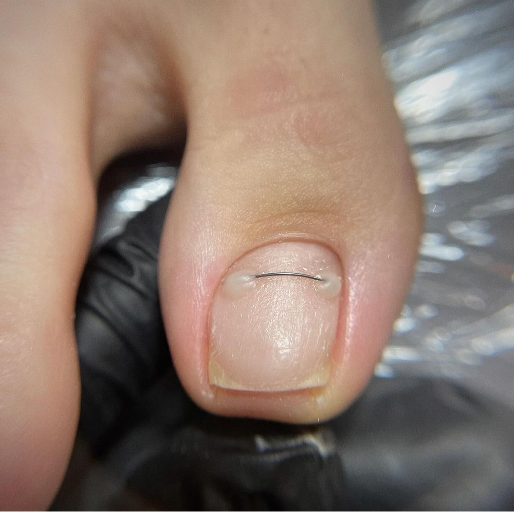 Установка титановой нити