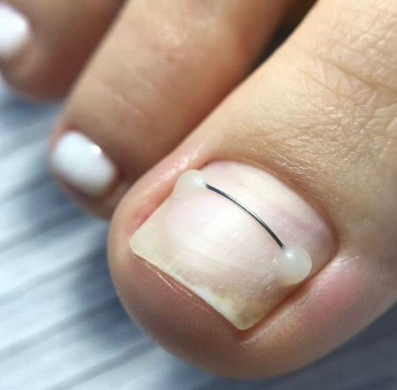 Титановая нить/light system