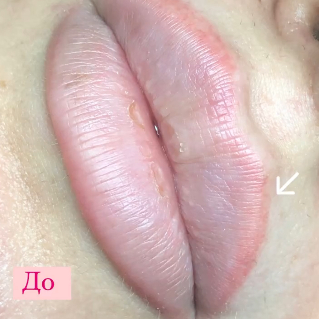 Коррекция перманента губ