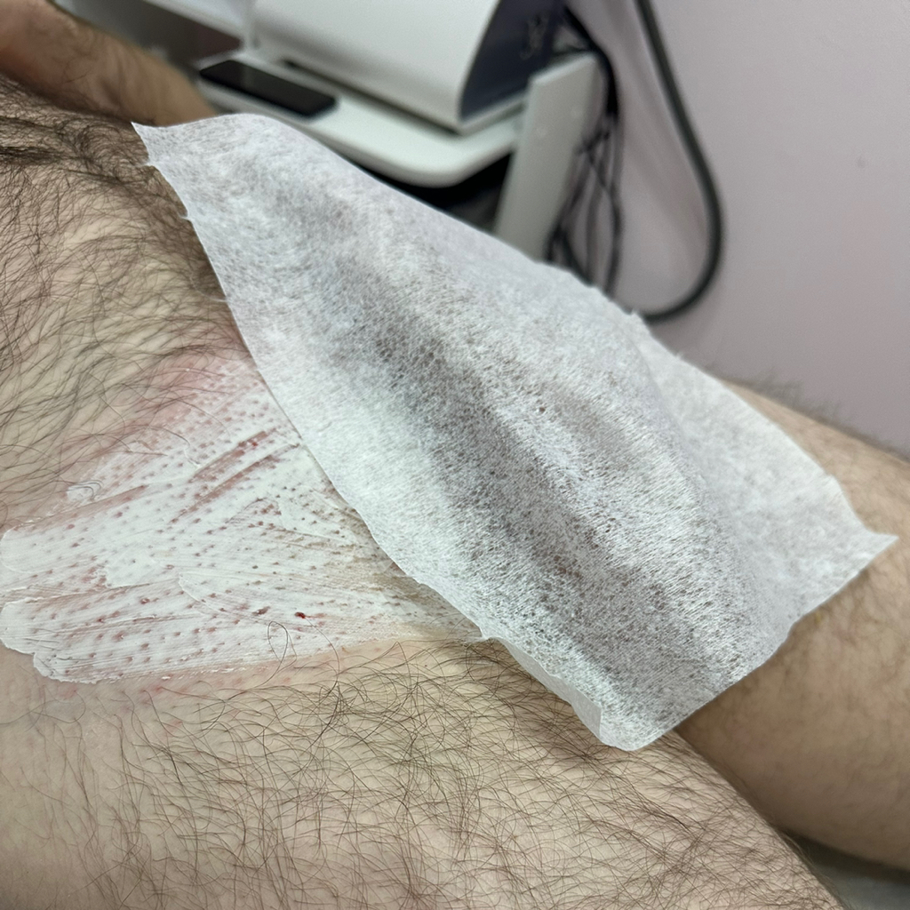 Бикини глубокое (пах)