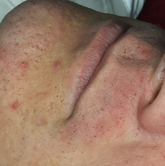 Зона над верхней губой