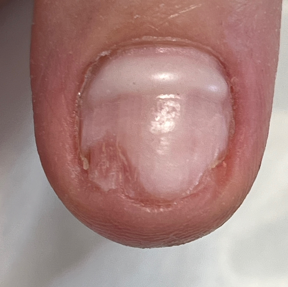 Установка пластины на ноготь (система фиксации ногтя)