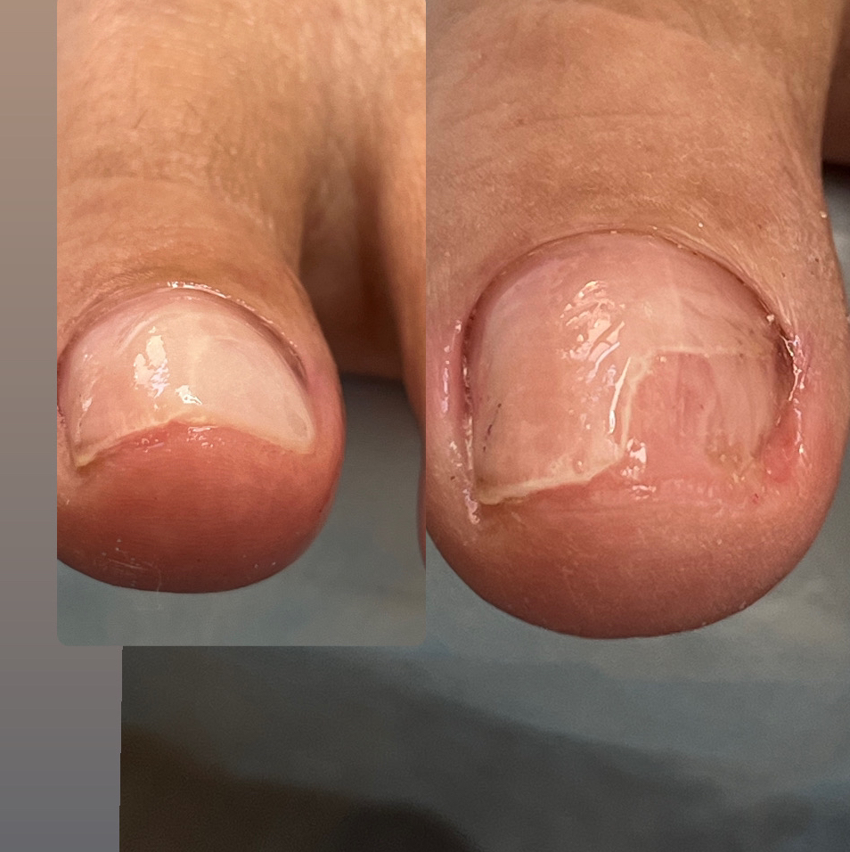 Протезирование ногтя 1 ед. (не имеет ничего общего с наращиванием, используется для восстановления ногтя)