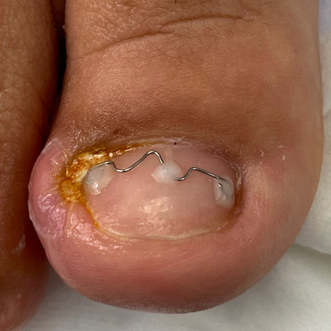 Установка корректирующей системы Унибрейс