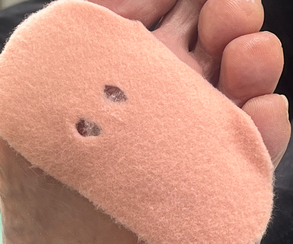 Наложение разгрузки, смена тампонады, тейпирование