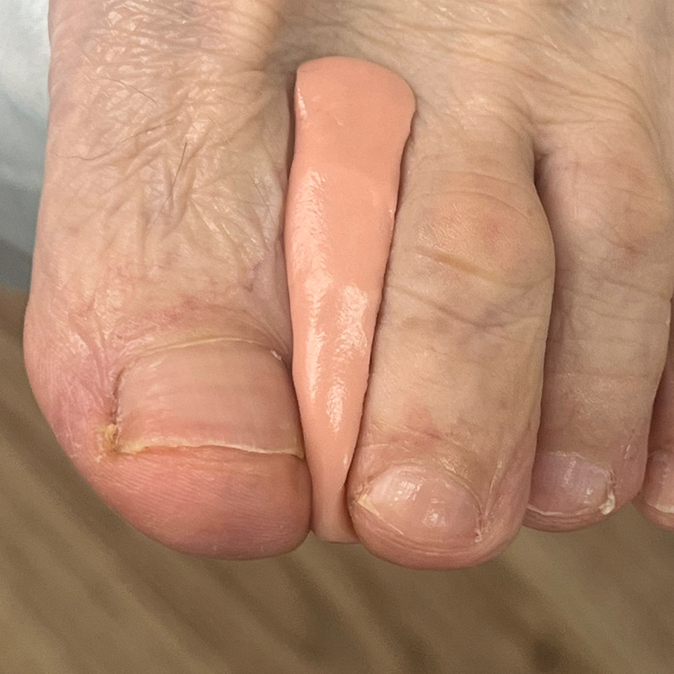 Изготовление индивидуального ортеза  (цена за 1 гр)