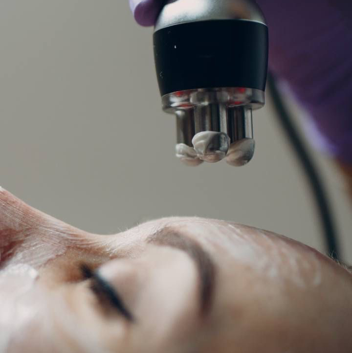 RF-лифтинг лица