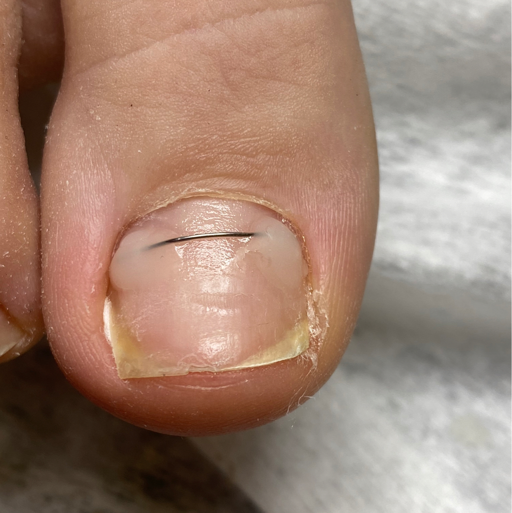 Коррекция титановой нити