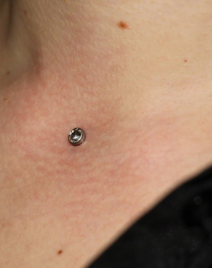 Установка микродермала | Installation microgermal