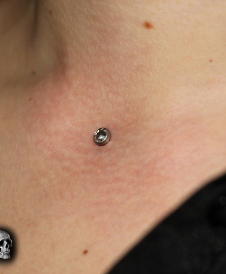 Удаление микродермала | Remove microdermal