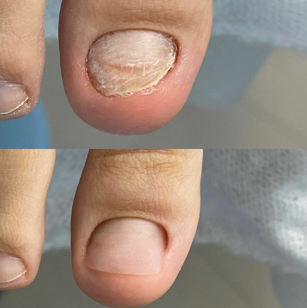 Протезирование ногтей 1 ед