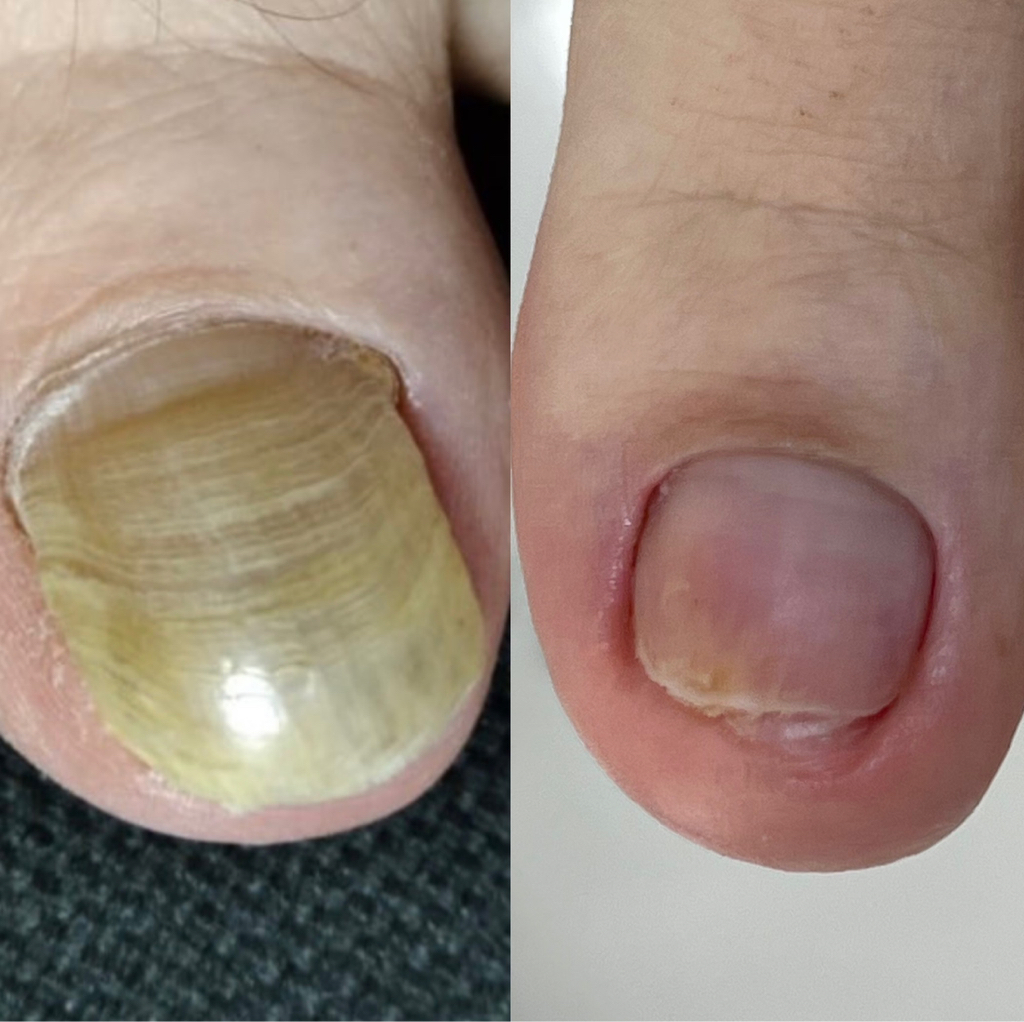 Зачистка онихомикоза/ онихогрифоза.  Стоимость за 1 единицу - 7.000 - 12.000 тенге.  Цена зависит от сложности