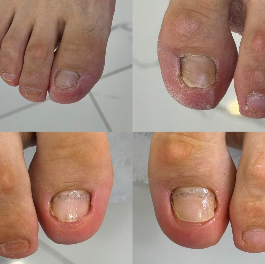 Коррекция, M Brace, скоба Фрезера, скоба 3ТО , титановой нити(1 единица, повторная процедура).  Стоимость - 13.000 тенге