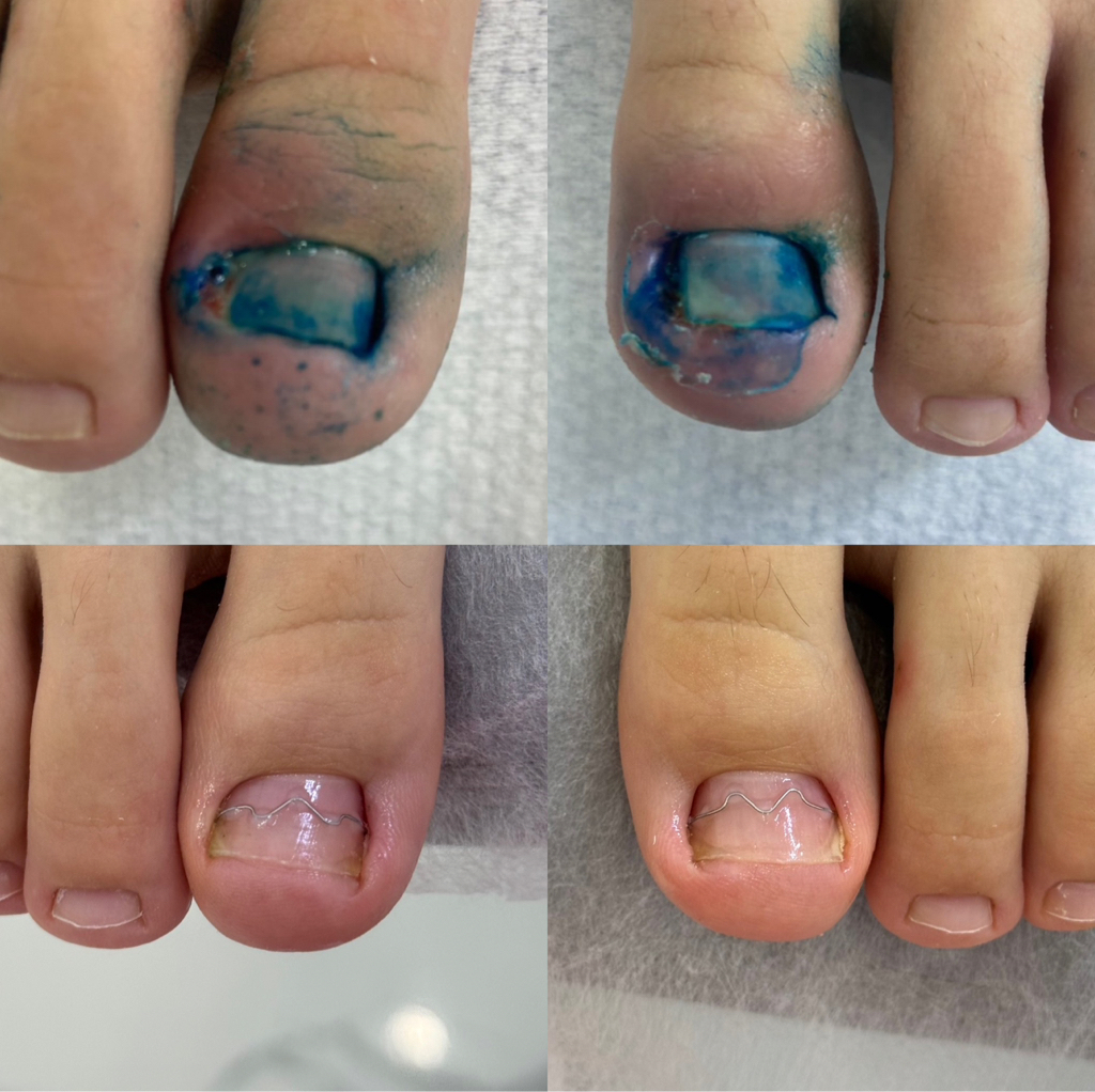 Установка MBrace , скоба 3ТО, скоба Фрезера, титановой нити -2 единицы.  Первая установка.   Стоимость - 35.000 тенге