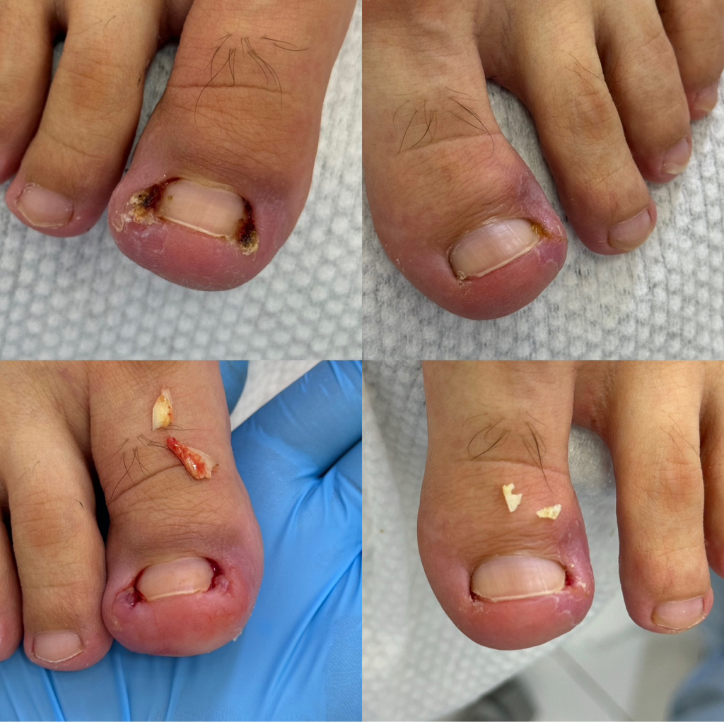 Удаление вросшего сегмента.  Стоимость - 1 ед. 10.000-15.000 тенге, 2 ед. - 15.000-20.000 тенге.  ( в зависимости от сложности работы, с гипергрануляц