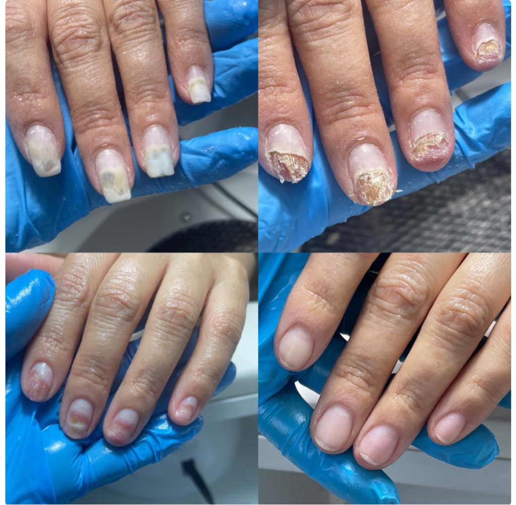 Зачистка онихолизиса на руках 10 ногтей (ожог ногтей).  Стоимость - 13.000 - 15.000 тенге