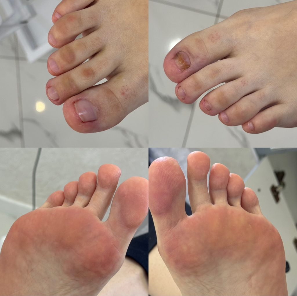 Комплексная подологическая обработка (Медицинский подологический педикюр).  Консультация, обработка стоп и ногтей, мозоли, натоптыши, зачистка, трещин